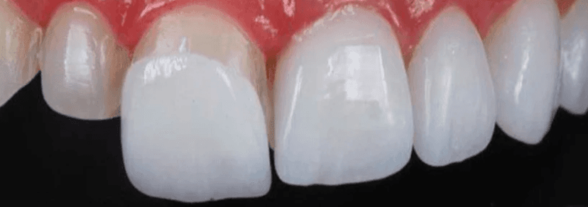 Paciente feliz após tratamento de Lentes de Contato Dental no bairro Pituba