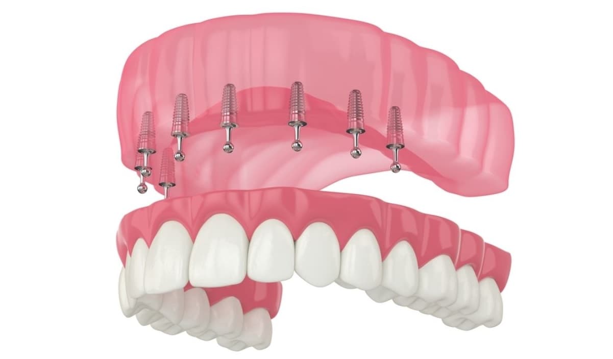 Paciente feliz após tratamento de Implante Protocolo no bairro Graça